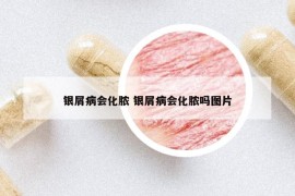 银屑病会化脓 银屑病会化脓吗图片