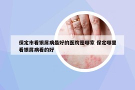保定市看银屑病最好的医院是哪家 保定哪里看银屑病看的好
