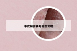 牛皮癣需要吃哪些食物