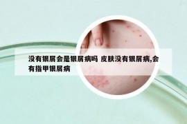 没有银屑会是银屑病吗 皮肤没有银屑病,会有指甲银屑病