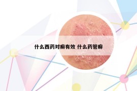 什么西药对癣有效 什么药管癣