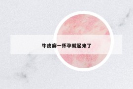 牛皮癣一怀孕就起来了