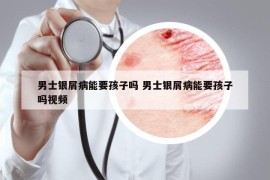 男士银屑病能要孩子吗 男士银屑病能要孩子吗视频