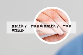 屁股上长了一个银屑病 屁股上长了一个银屑病怎么办
