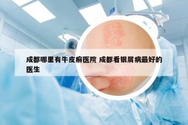 成都哪里有牛皮癣医院 成都看银屑病最好的医生