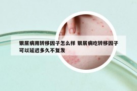 银屑病用转移因子怎么样 银屑病吃转移因子可以延迟多久不复发