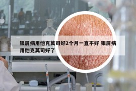银屑病用他克莫司好2个月一直不好 银屑病用他克莫司好了