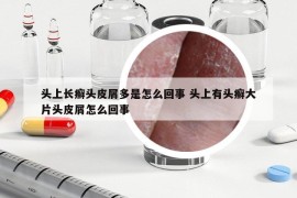 头上长癣头皮屑多是怎么回事 头上有头癣大片头皮屑怎么回事