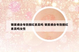 银屑病会导致胆红素高吗 银屑病会导致胆红素高吗女性