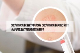 复方氨肽素治疗牛皮癣 复方氨肽素片配合什么药物治疗银屑病效果好