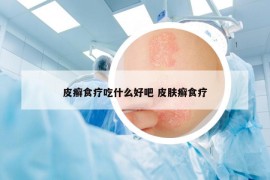 皮癣食疗吃什么好吧 皮肤癣食疗