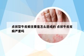 点状型牛皮癣主要是怎么造成的 点状牛皮皮癣严重吗