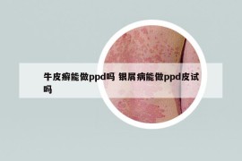 牛皮癣能做ppd吗 银屑病能做ppd皮试吗