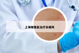 上海哪里能治疗白癜风
