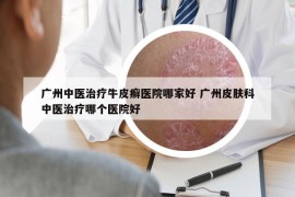 广州中医治疗牛皮癣医院哪家好 广州皮肤科中医治疗哪个医院好