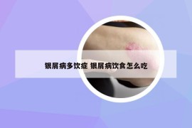 银屑病多饮症 银屑病饮食怎么吃