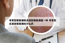 寻常型银屑病和点滴型银屑病是一种 寻常型点滴状银屑病吃什么药
