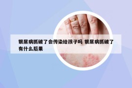 银屑病抓破了会传染给孩子吗 银屑病抓破了有什么后果