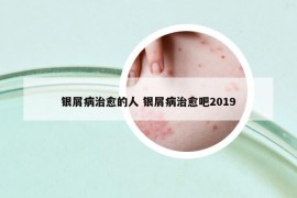 银屑病治愈的人 银屑病治愈吧2019