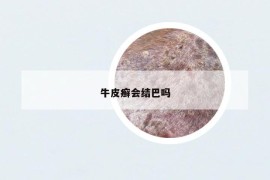 牛皮癣会结巴吗