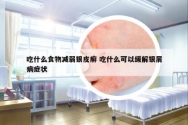 吃什么食物减弱银皮癣 吃什么可以缓解银屑病症状