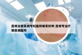 昆明治银屑病专科医院哪家好啊 昆明专治疗银屑病医院