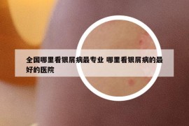 全国哪里看银屑病最专业 哪里看银屑病的最好的医院