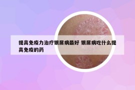 提高免疫力治疗银屑病最好 银屑病吃什么提高免疫的药