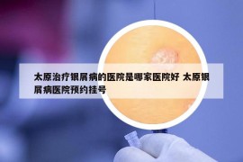 太原治疗银屑病的医院是哪家医院好 太原银屑病医院预约挂号