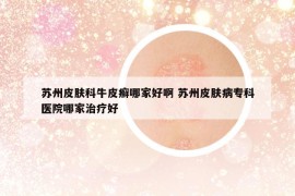 苏州皮肤科牛皮癣哪家好啊 苏州皮肤病专科医院哪家治疗好