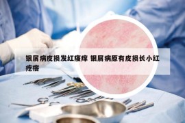 银屑病皮损发红瘙痒 银屑病原有皮损长小红疙瘩