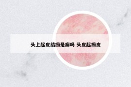 头上起皮结痂是癣吗 头皮起痂皮