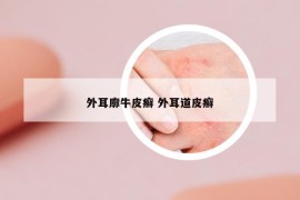 外耳廓牛皮癣 外耳道皮癣