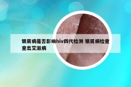 银屑病是否影响hiv四代检测 银屑病检查查出艾滋病