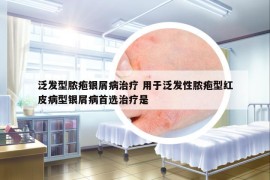 泛发型脓疱银屑病治疗 用于泛发性脓疱型红皮病型银屑病首选治疗是
