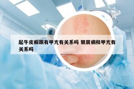起牛皮癣跟有甲亢有关系吗 银屑病和甲亢有关系吗