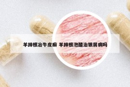 羊蹄根冶牛皮癣 羊蹄根泡醋治银屑病吗