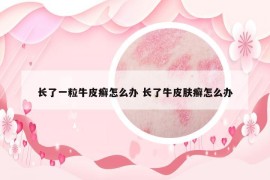 长了一粒牛皮癣怎么办 长了牛皮肤癣怎么办