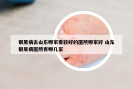 银屑病去山东哪家看较好的医院哪家好 山东银屑病医院有哪几家