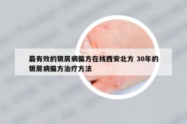 最有效的银屑病偏方在线西安北方 30年的银屑病偏方治疗方法