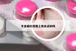 牛皮癣红疙瘩上有白点的吗