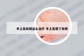 手上出白斑这么治疗 手上出现了白斑