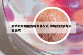廊坊银屑病医院哪家最权威 廊坊皮肤病专科医医院