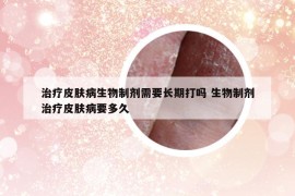 治疗皮肤病生物制剂需要长期打吗 生物制剂治疗皮肤病要多久