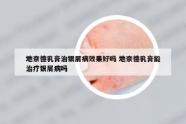 地奈德乳膏治银屑病效果好吗 地奈德乳膏能治疗银屑病吗
