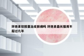 环孢素软胶囊治皮肤病吗 环孢素最长服用不超过几年