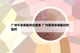 广州牛皮癣医院在哪里 广州看银屑病最好的医院