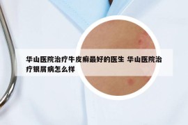 华山医院治疗牛皮癣最好的医生 华山医院治疗银屑病怎么样