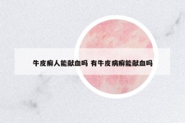 牛皮癣人能献血吗 有牛皮病癣能献血吗