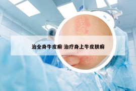 治全身牛皮癣 治疗身上牛皮肤癣